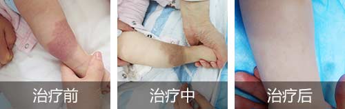 海口祛除胎记-小孩身上的胎记会带来哪些危害?