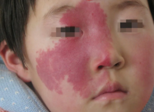 孩子脸上的鲜红斑痣随着年龄不断变大怎么处理?