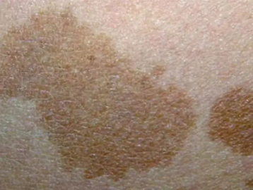 ����ר��̥��Ƥ��ҽ�����ѣ���Կ��Ȱ�Ҫ�ÿ�ѧ�ķ�ʽ����