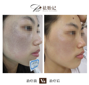 在海南如何选择一家专业的祛除胎记医院?