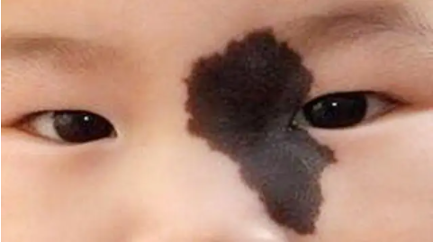 黑色胎记的临床表现是什么,怎么治疗好?