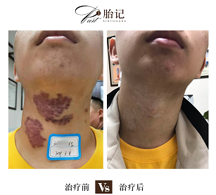 皮肤医院激光去胎记的效果怎么样?