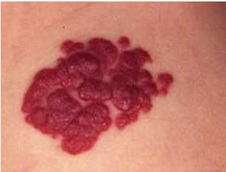 不断增加的血管瘤对病人造成哪些影响?