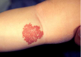 ����״Ѫ����������������һ�����