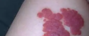 孩子腿部患有血管瘤,家长切不可放任不管!