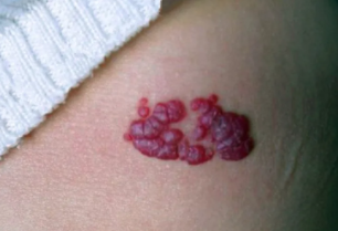 ��ô��ֹѪ�����ķ���,�����γ�ԭ����ʲô��