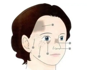 去海南皮肤医院治疗太田痣要花多少钱?