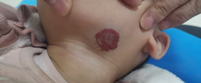 小儿混合型血管瘤的症状表现有哪些?