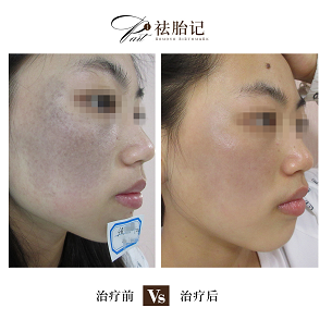 面部太田痣要治疗多少次,才能彻底干净?