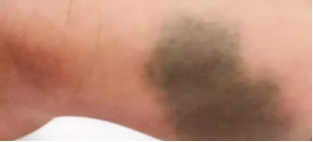 为什么你的青色胎记越治越严重呢?