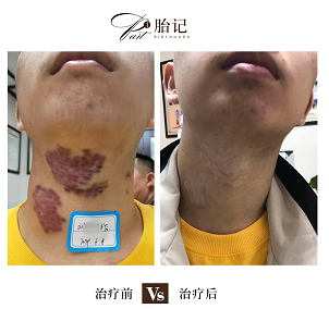 你知道黑毛痣会对身体产生很大的影响吗?