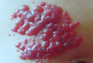 血管瘤的不同症状会引发皮肤痛痒感