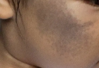 患者身上的青胎记能一次治好吗?