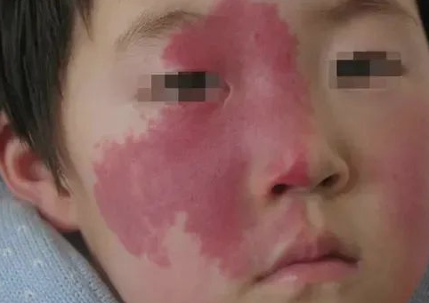 皮肤医生带你了解各类胎记症状特征