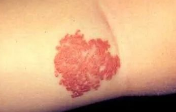 婴儿出生长有血管瘤能治疗吗?