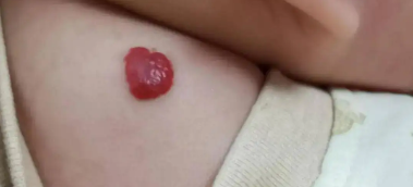 皮肤医生:儿童血管瘤的诊治方法