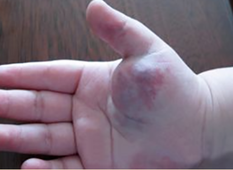 ����״Ѫ�����ľ���֢״����