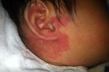 海口胎记治疗多少钱,影响鲜红胎记治疗费用因素