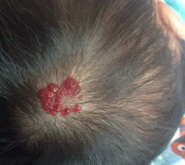 ͷ��Ѫ�����Ƿ��Ӱ�캢�ӵ�������