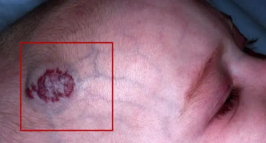 Ѫ�����𽥶񻯻�����Щ֢״��