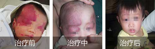 婴儿在治疗胎记之后该如何护理?