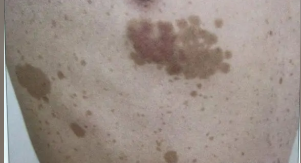 ���Ȱ߷���������Щ֢״��Ҫ�������ӣ�