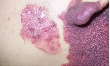 引起胎记的因素是什么,会有哪些特征?