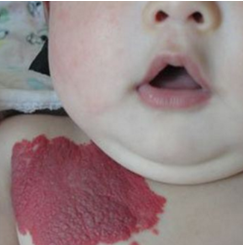 血管瘤对健康有哪些危害,手术后是否有复发的可能?