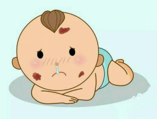 婴儿有胎记可以马上祛除吗?