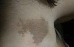 治疗胎记需要注意什么,激光祛除胎记怎么样?