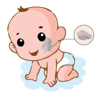 海口,在治疗太田痣的过程中需要注意些什么?