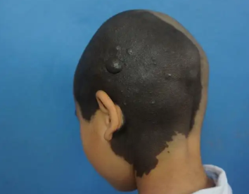 ��ë���������ʲô���������֢״����Щ��