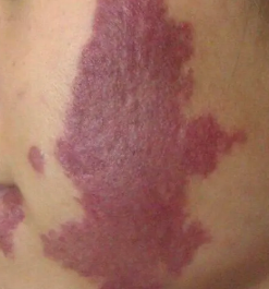 一起来了解,鲜红斑痣患者需要注意什么?