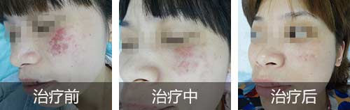 带你了解,什么原因导致后天形成胎记?