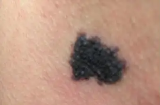 以下四种胎记需要特别留意,并及时治疗!