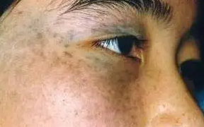 太田痣有哪些颜色?有哪些表现?