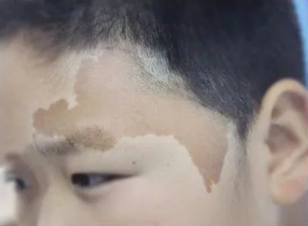 ҽ�������ʲô�������Ʊ��Ŀ���ɫ̥�ǣ�