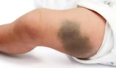 蒙古斑如何形成?