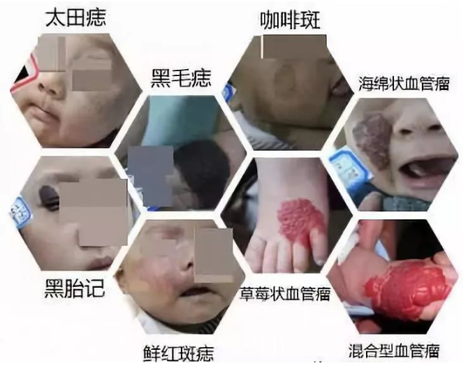 海口皮肤医生科普:家长想了解的胎记常识