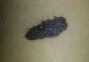 胎记科普:什么类型的胎记需要特别留意?