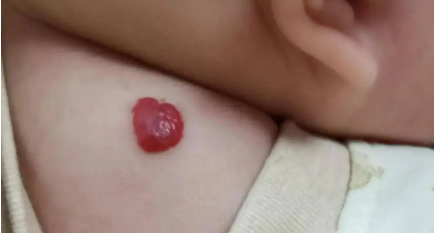 解析:新生儿血管瘤的早期表现有哪些?