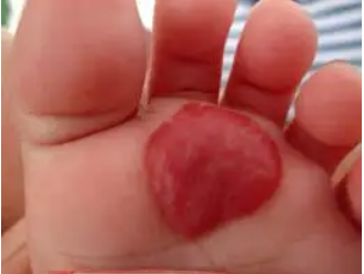 海口医生解惑:初生婴儿手臂上有胎记要治疗吗?