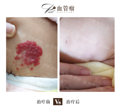 海口皮肤医院激光治疗胎记需要多少钱?