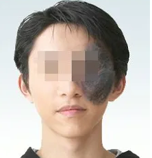 医生,激光治太田痣会有反黑的现象吗?