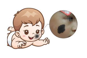 胎记的病因是什么,是福还是祸?