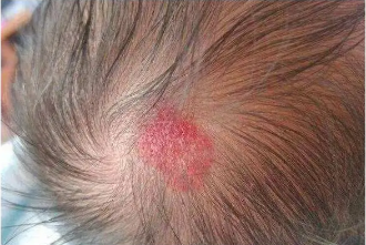 婴儿红色胎记的三种临床表现