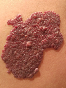 红色胎记的具体症状是什么,有哪些危害?