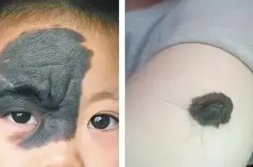 黑毛痣的症状表现,以及产生恶变的情况