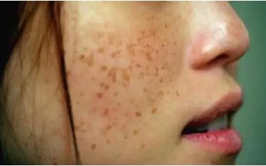 海口皮肤医生科普:咖啡斑与色素斑的区别