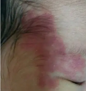 ����Ƥ��ҽ����Ӥ��̥�ǶԶ�ͯ��ʲôΣ����